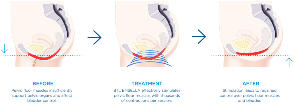 Graphic illustration of the before, during, and after treatment of Emsella