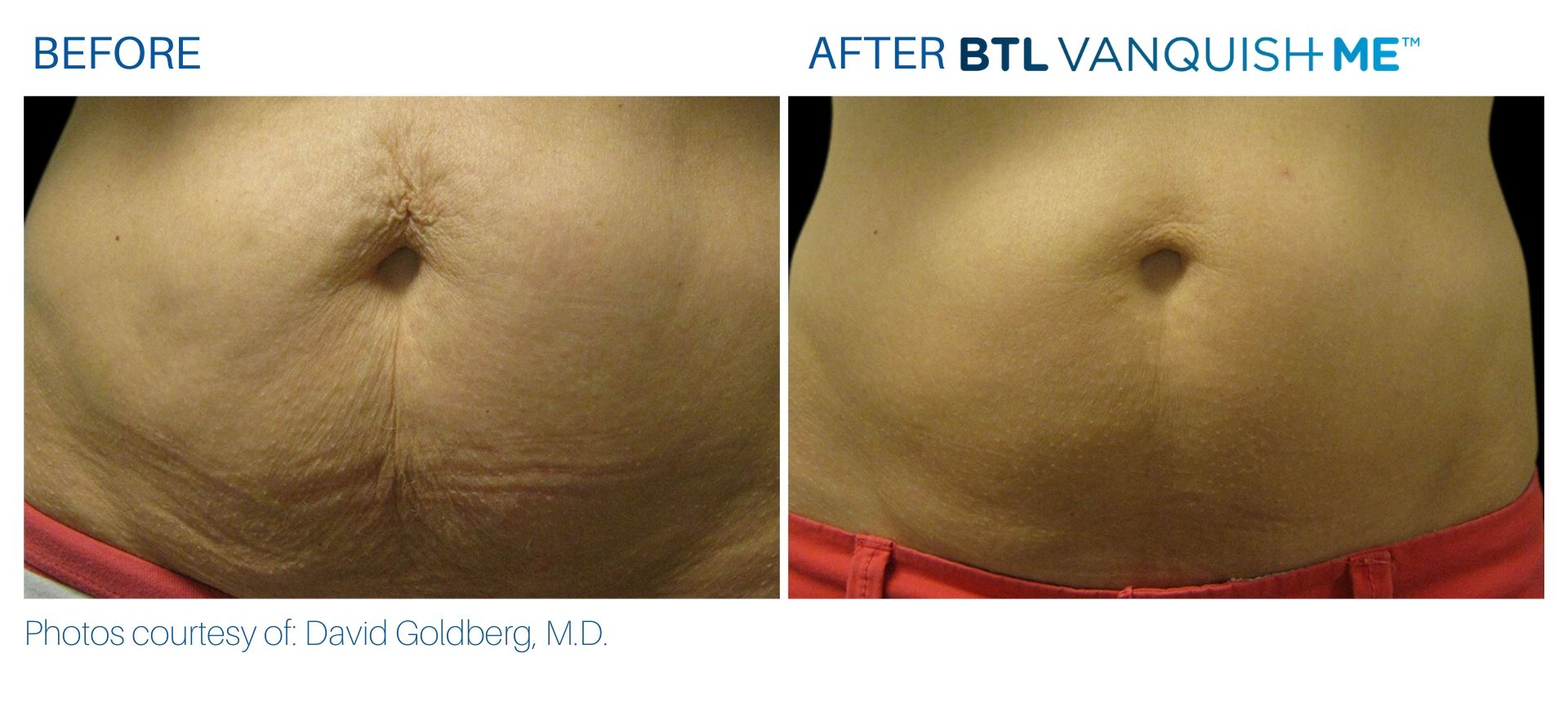BTL Vanquish ME before and after abdomen in Somers, CT