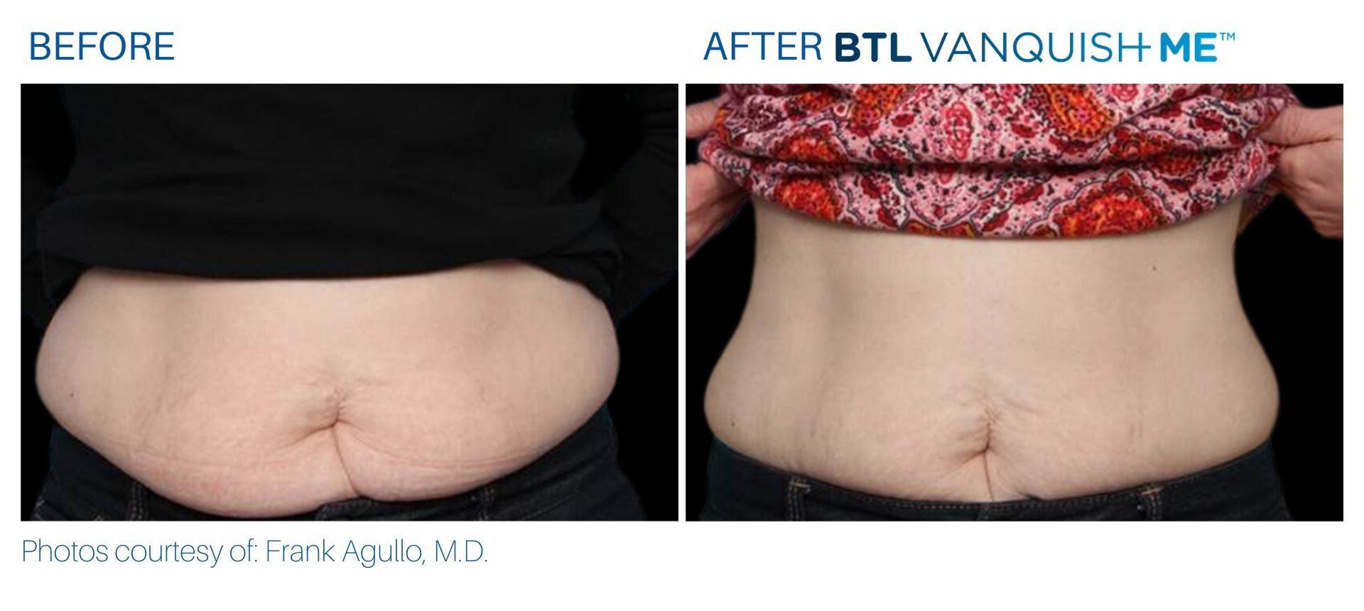BTL Vanquish ME before and after Body Reflections in Somers, CT