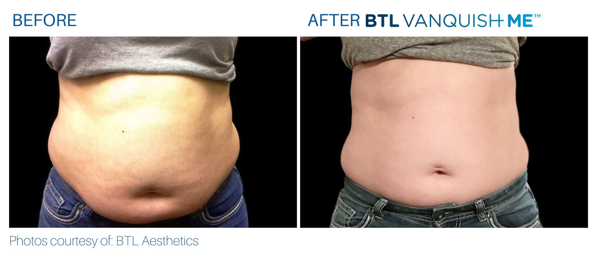 BTL Vanquish ME before and after abdomen Body Reflections in Somers, CT