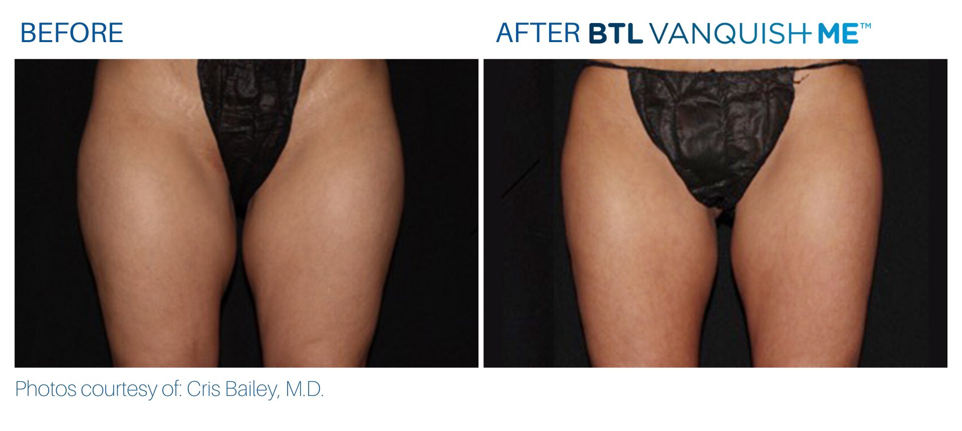BTL Vanquish ME before and after thighs Body Reflections in Somers, CT