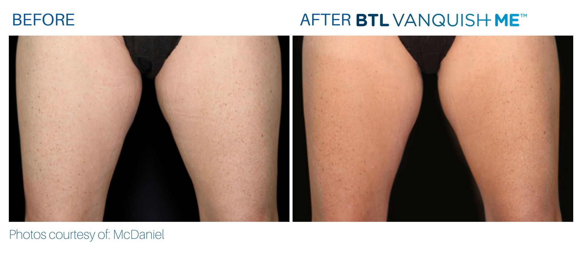 BTL Vanquish ME before and after thighs in Somers, CT